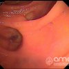 Diverticulo duodenal