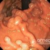 Imágenes endoscópicas » Estómago » Polipos gástricos