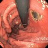 Úlcera gástrica isquemica