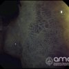 Adenoma de colon