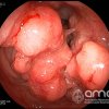 Cancer de colon