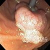Adenoma duodeno