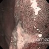Erosión duodenal