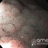 Imágenes endoscópicas » Duodeno » Metaplasia gástrica