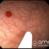 Imágenes endoscópicas » Estómago » Angioectasia